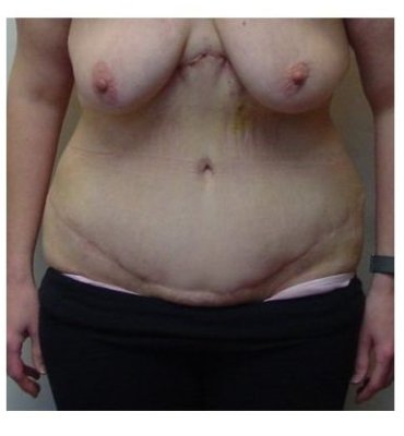 Second-stage upper abdominoplasty after